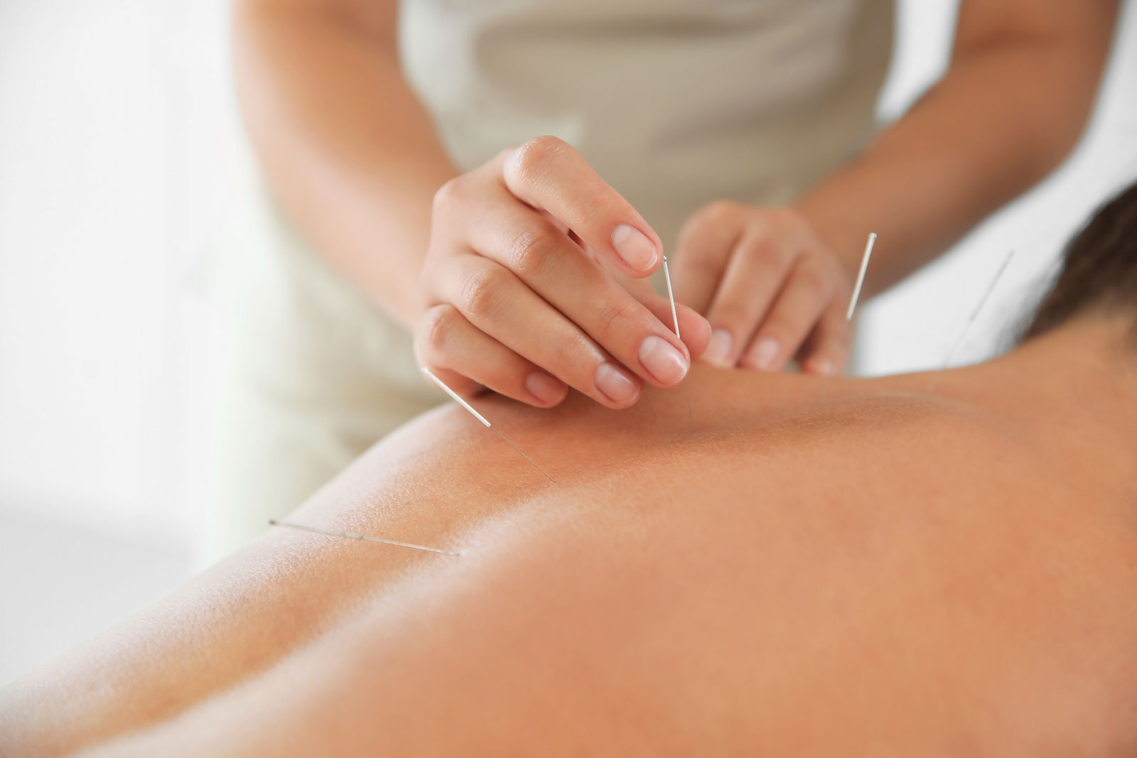 Acupuncture is one of the ICBC physiotherapy treatments